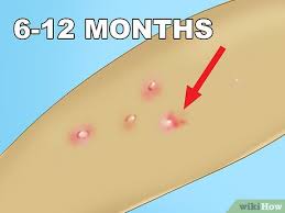 Eine Dellwarzen Infektion Erkennen 11 Schritte Mit Bildern Wikihow