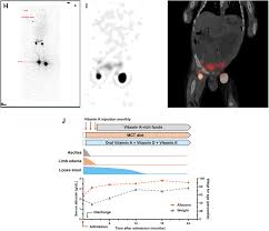 Image result for Intestinal Enteropathy