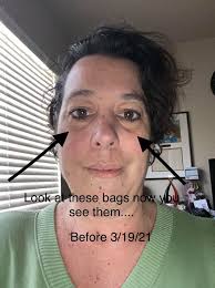 Eye rescue serum effectiveness