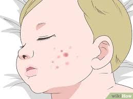 If your baby has acne, dermatologists recommend that you: 3 Ways To Get Rid Of Baby Acne Wikihow