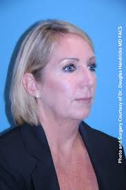 Facelift Before and After Photos by Douglas Hendricks, MD; Newport Beach,  CA