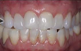 Although there aren't any studies proving tooth bone loss is reversible naturally, proper dental care, attention to your health and supplementation can help prevent it and slow it down. Can Receding Gums Be Reversed