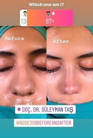 Thick Skin Bulbous Tip Rhinoplasty Assoc Prof Dr Suleyman Tas Thick Skin Bulbous Tip Rhinoplas Rhinoplasty Nose Jobs Nose Surgery Nose Surgery Rhinoplasty