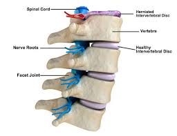 Can I Lift Weights With A Herniated Disc Herniated Disc Herniated Herniated Disc Exercise