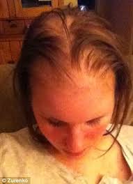 Dermatomyositis New Mother Left Fighting For Her Life After An Afternoon In The Sun Triggered Rare Condition That Led To Seizures Daily Mail Online Read each question and then choose the answer you think is correct.