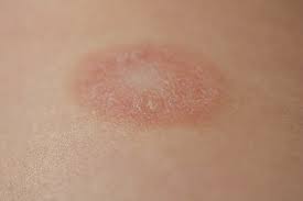 Pityriasis rosea is a rash that usually begins as a large circular or oval spot on your chest, abdomen or back. Roschenflechte Oder Pityriasis Rosea