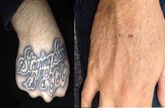 With a true passion for skin, lasers, tattoo removal and tattoo… Laser Tattoo Removal Virginia Beach Laser Tattoo Removal