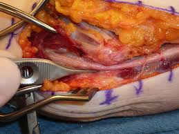 Cubital Tunnel Syndrome Cancer Therapy Advisor