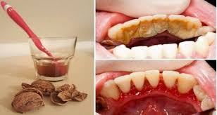 That said, if it's absolutely impossible or impractical or unsafe for you to do so, you can scale tartar off your cat's teeth at home. How To Get Tartar Off Your Teeth At Home Teeth Poster