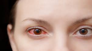 Mata bengkak dan berair bisa disebabkan oleh alergi mata. Mata Merah Jangan Biarkan Berlama Lama