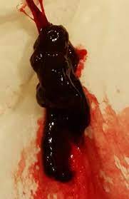 The bleeding can be heavy with clots, but it slowly tapers off over days before stopping, usually within two weeks. 3 Week Blood Clotting Miscarriage Novocom Top