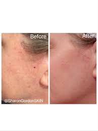 How to tell the difference. Cherry Angiomas Sharon Gordon Skin
