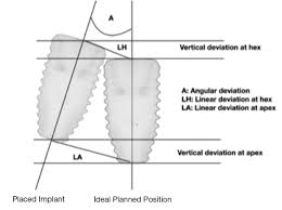 a digital workflow for guided implant surgery using cerec