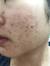 trattamento macchie acne