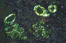 Amyloid fibril congo red complex demonstrates green birefringence owing to the parallel alignment of dye molecules along the β pleated sheath. Renal Aa Amyloidosis Congo Red 100 Polarized Light Download Scientific Diagram