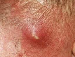 Image result for carbuncle