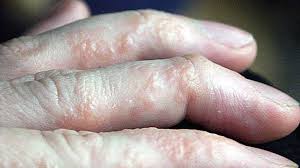 7 Types Of Eczema Symptoms Causes And Pictures
