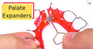 Maybe you would like to learn more about one of these? Palate Expanders The Most Important Orthodontic Appliance