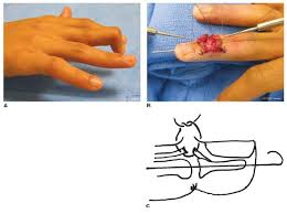 Mallet finger can be due to disruption of the tendon alone or it can involve a small fragmentation of the bone. Traumatic Tendon Injuries Obgyn Key