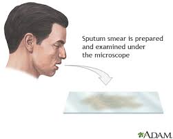 Image result for Sputum