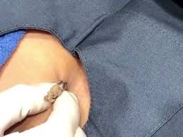 Ingrown hairs most commonly appear in the beard area, including the chin and cheeks and, especially, the neck. Dr Pimple Popper See This Giant Armpit Cyst Pour Out Looking Like A Turkey Meatball