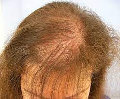 Thyroid Hormones Mitochondrial Functioning And Hair Loss Hormones Matter