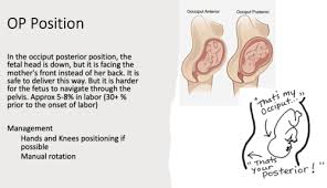 Image result for Manual Rotation in Occipitoposterior Presentation