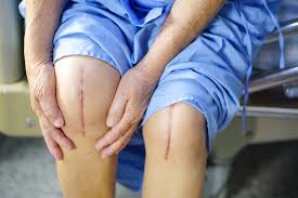 Site Search Discovery Powered By Ai Knee Replacement Recovery Knee Replacement Knee Surgery Recovery