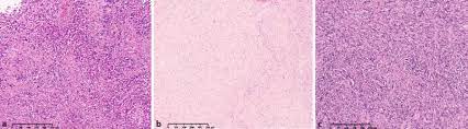 Malignant pleural mesothelioma (mpm) is a relatively. Examples Of Malignant Pleural Mesothelioma Mpm Epithelioid Mpm A Download Scientific Diagram