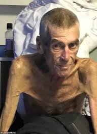 Your emaciated man stock images are ready. Six Stone Emaciated Man 64 Left Starving And Unable To Stand But Deemed Fit To Find Work Dies Daily Mail Online