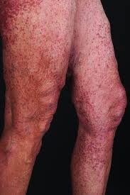 Check spelling or type a new query. Mastozytose Pathogenese Klinik Und Therapie Wagner 2018 Jddg Journal Der Deutschen Dermatologischen Gesellschaft Wiley Online Library