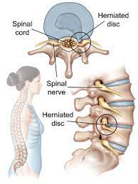 Maybe you would like to learn more about one of these? What Is A Herniated Disc Can Chiropractic Help Leahy Chiropractic Better Health Naturally