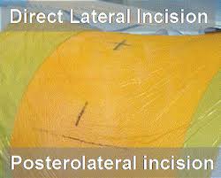 He is accepting new patients and has indicated that he accepts telehealth appointments. Extreme Lateral Interbody Fusion Xlif A Novel Surgical Technique For Anterior Lumbar Interbody Fusion Sciencedirect