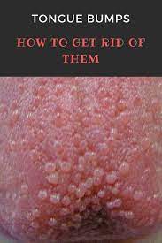 Tongue Bumps How To Get Rid Of Them Tongue Bumps Bumps On Tongue How To Get Rid