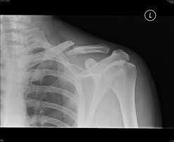 Broken Bones The Dark Side Broken Bone Broken Collar Bone Heal Broken Bones