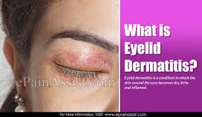 It's your eyes trying to force their way out of your head. Eyelid Dermatitis Causes Symptoms Treatments Diagnosis How Long Does It Last