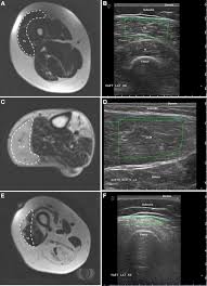Jun 17, 2021 · the foot is the region of the body distal to the leg and consists of 28 bones. Quantitative Muscle Mri And Ultrasound For Facioscapulohumeral Muscular Dystrophy Complementary Imaging Biomarkers Springerlink