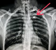 Chest Xray Of A Patient Shot In The Chest It S In The Lung And Missed The Heart And Aorta Radiologist Radio Diagnostic Imaging Radiology Radiologist
