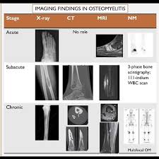 Image result for Osteomyelitis Bone Scan