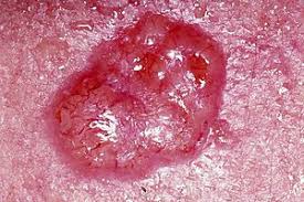 Melanomas can occur anywhere on the skin, but are most common on the chest and back in men, and the legs in women. Skin Cancer Wikipedia