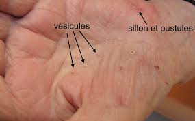 07 mar, 2021 post a comment. Dermato Info La Gale