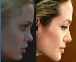 Angelina Jolie Plastic Surgery Before And After Women Angelina Jolie Nose Job Angelina Jolie Plastic Surgery Angelina Jolie Nose