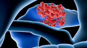 If they do show, there are three early signs to be some of the first noticeable symptoms of the cancer could be mistaken for those of less serious health conditions. Early Diagnosis Of Pancreatic Cancer And Challenges During Covid 19