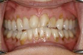 199 140 просмотров 199 тыс. How To Remineralize Teeth Reddit Teethwalls