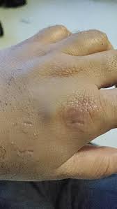 Image result for Human Bite