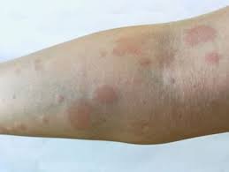 Lupus Eritematoso Sistemico