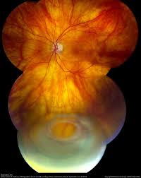 Image result for Lens Dislocation