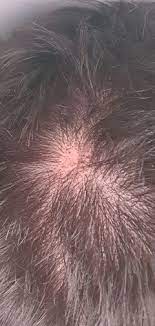 È normale perdere i capelli ogni giorno, tuttavia, perderne una . Piccolo Buco Nei Capelli