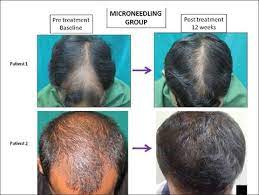 The company, the scientist explains, was founded by a group of scientists who have been working on this problem for several years. Follica Hair Loss Treatment For 2019 Hairliciously