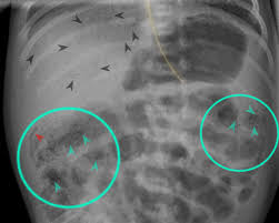 Image result for Necrotizing Enterocolitis